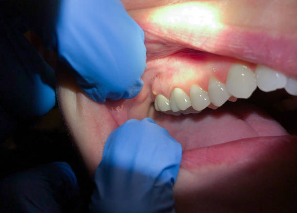 Best Emergency Dentist for Lost Fillings or Crowns in Cricket, NC